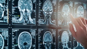 La Fisioterapia se consolida como una herramienta esencial en el tratamiento de la esclerosis múltiple